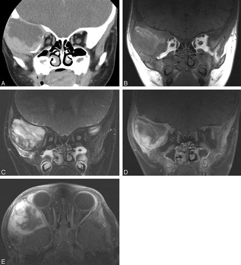 noduläre fasziitis|Nodular Fasciitis in the Head and Neck: CT and MR。